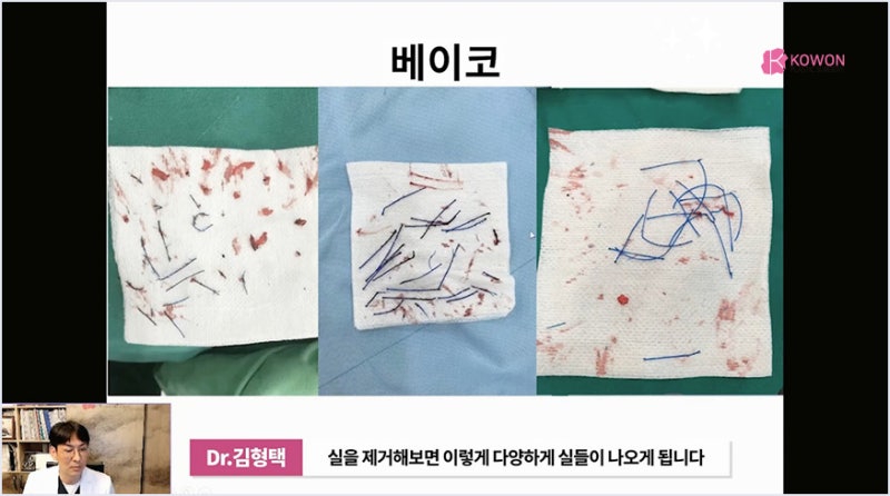 서초성형외과 미주코 방식과 한꺼번에 제거해야 하는 이유 사진 6
