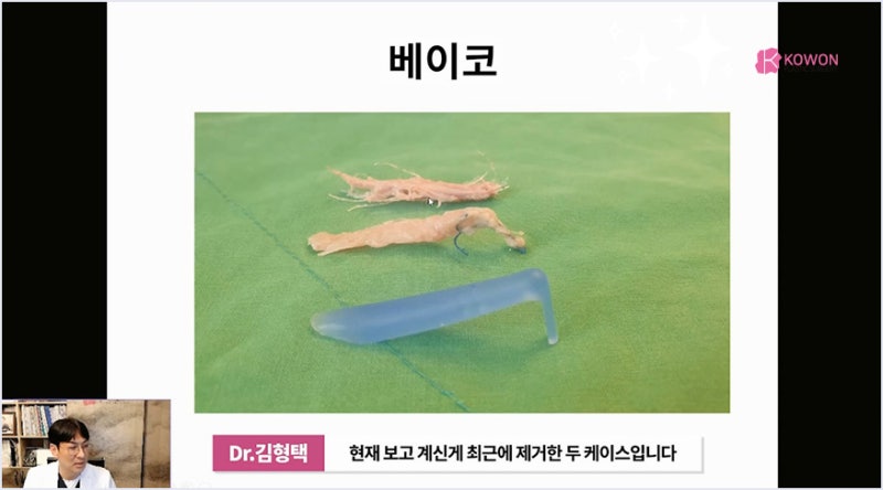 서초성형외과 미주코 방식과 한꺼번에 제거해야 하는 이유 사진 10