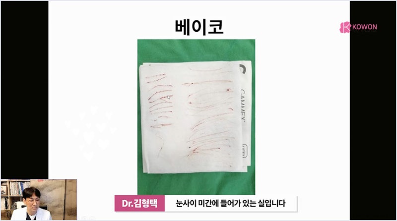 서초성형외과 미주코 방식과 한꺼번에 제거해야 하는 이유 사진 8