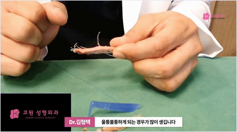 서초성형외과 미주코 방식과 한꺼번에 제거해야 하는 이유 사진 14