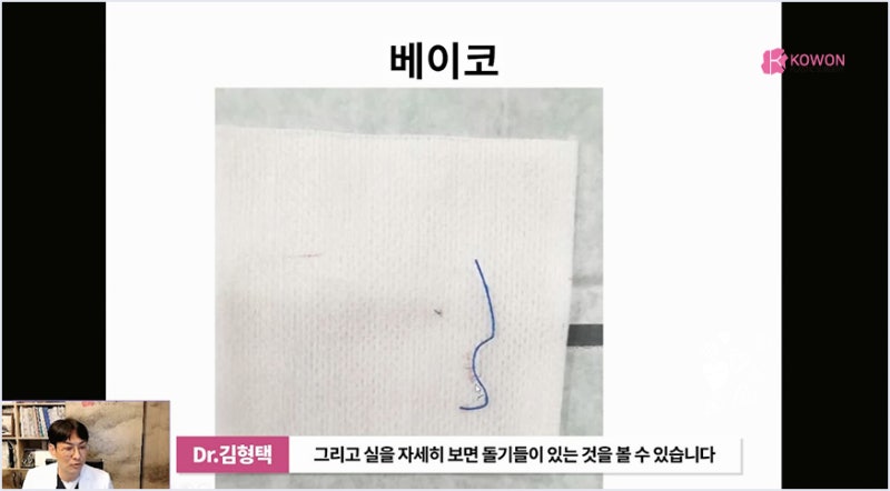 서초성형외과 미주코 방식과 한꺼번에 제거해야 하는 이유 사진 9