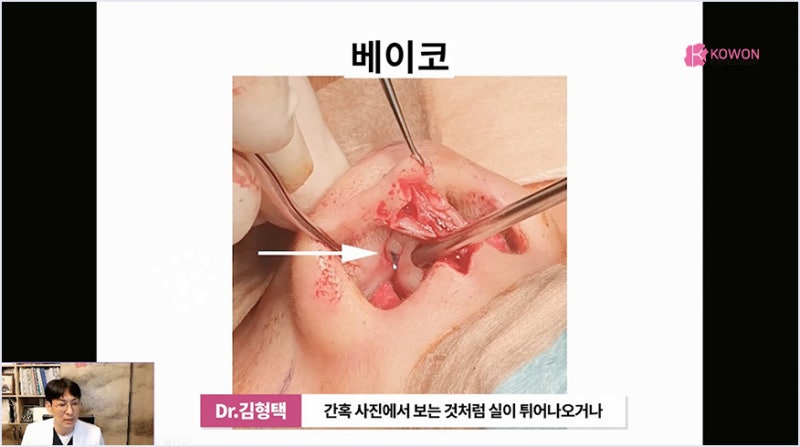 서초성형외과 미주코 방식과 한꺼번에 제거해야 하는 이유 사진 5