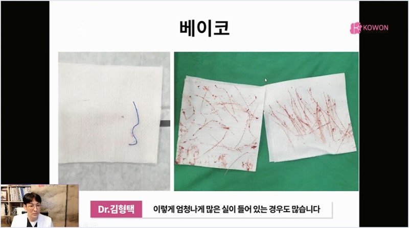 서초성형외과 미주코 방식과 한꺼번에 제거해야 하는 이유 사진 7