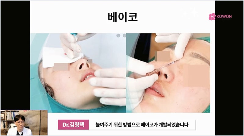 서초성형외과 미주코 방식과 한꺼번에 제거해야 하는 이유 사진 4