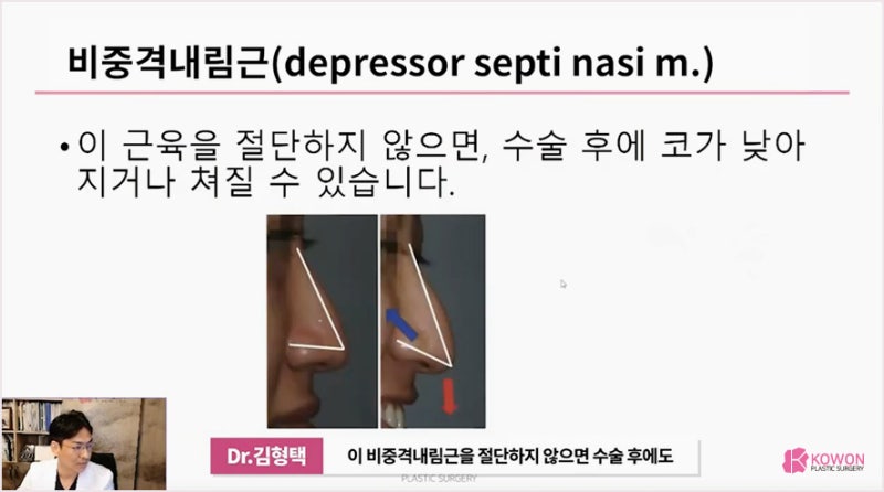 코수술전문 성형외과, 화살코 긴 코 왜 그럴까? 사진 10