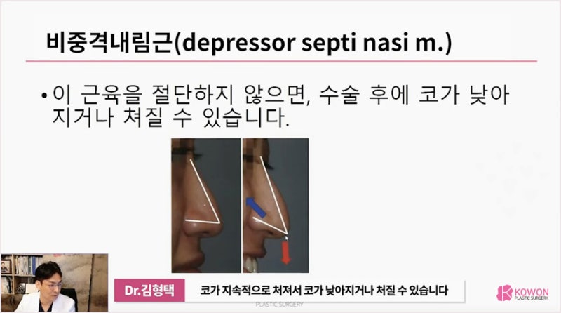 코수술전문 성형외과, 화살코 긴 코 왜 그럴까? 사진 11
