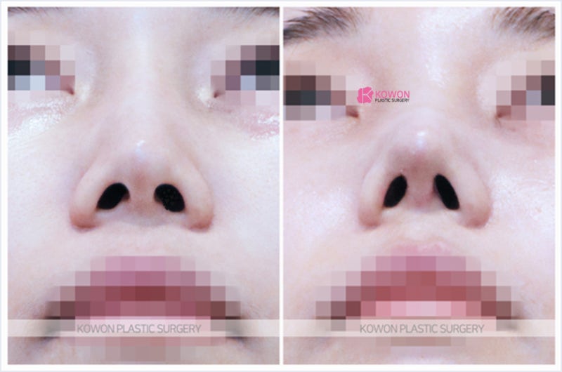 강남코재수술잘하는곳 콧대울퉁불퉁 증상 성형 전후 사진 7