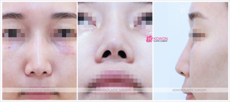 강남코재수술잘하는곳 콧대울퉁불퉁 증상 성형 전후 사진 2
