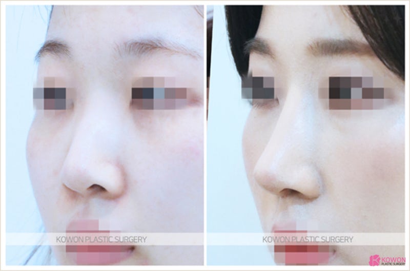 신사동성형외과 긴코성형 수술 전후 사례