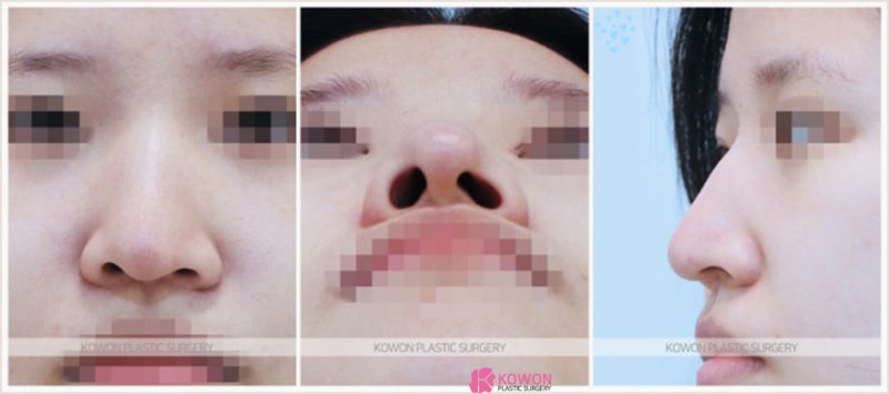 코잘하는성형외과 여자매부리코 교정 성공 사례 사진 2