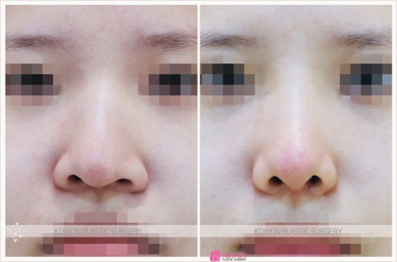 코잘하는성형외과 여자매부리코 교정 성공 사례