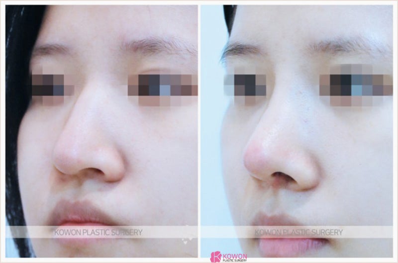 코잘하는성형외과 여자매부리코 교정 성공 사례 사진 5