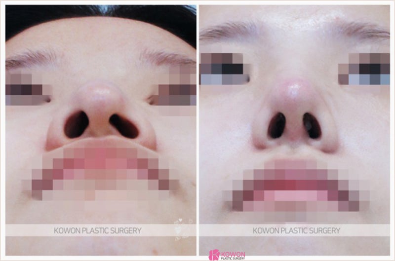 코잘하는성형외과 여자매부리코 교정 성공 사례 사진 7