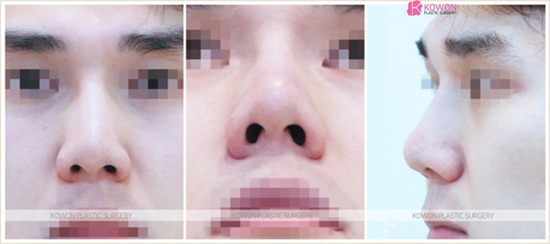 서울남자코성형 낮은코수술 전후 후기 사례 사진 2