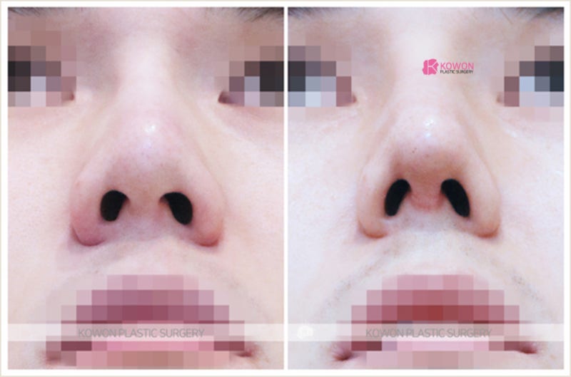 서울남자코성형 낮은코수술 전후 후기 사례 사진 7