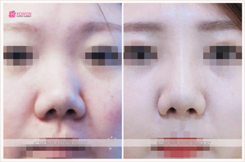 강남코재수술 들창코성형 전문의 전후 사례 사진 7