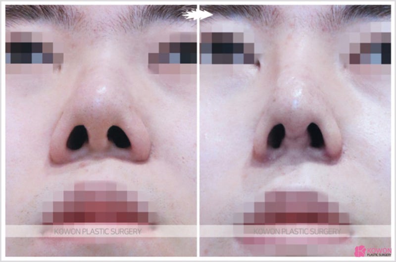 학동역성형외과 코끝세우기 복코 수술후기 사진 7