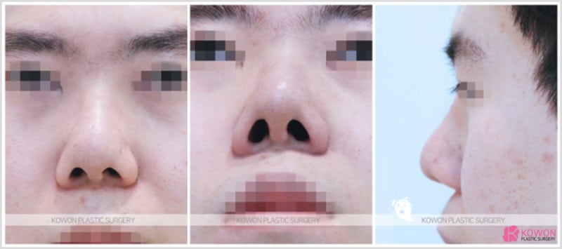 학동역성형외과 코끝세우기 복코 수술후기