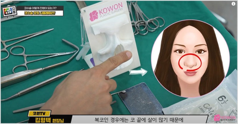 코수술유명한곳 매부리깎기 비중격 성형 전문병원 사진 10