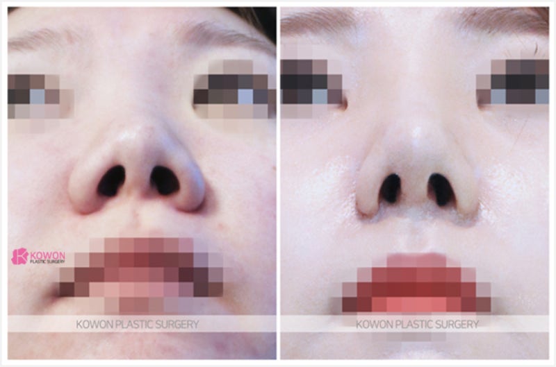 강남코재수술 들창코성형 전후 사진 수술 방법 사진 6