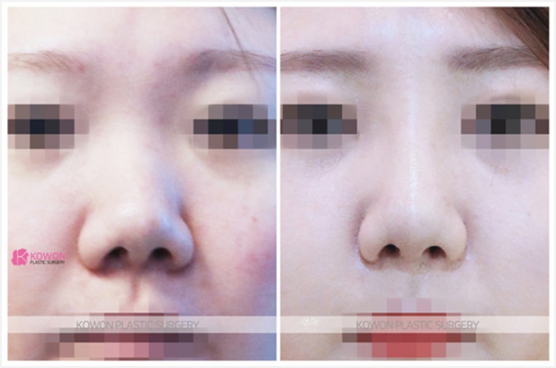 강남코재수술 들창코성형 전후 사진 수술 방법 사진 7