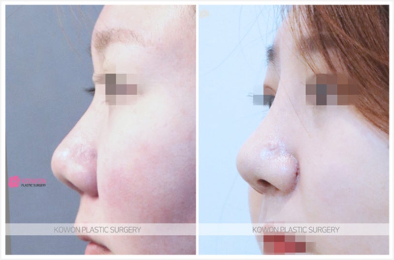 강남코재수술 들창코성형 전후 사진 수술 방법 사진 4