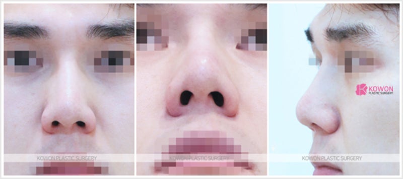 서울남자코성형 낮은코수술 사례 코끝 전후 사진 사진 2