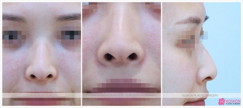 역삼성형외과 용코 수술 전후 사진 사진 2