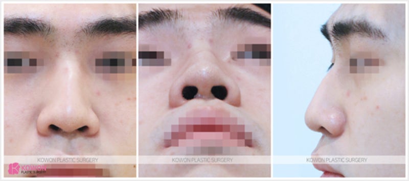 신사역성형외과 남자매부리코수술 연골 묶기 전후 사진 2
