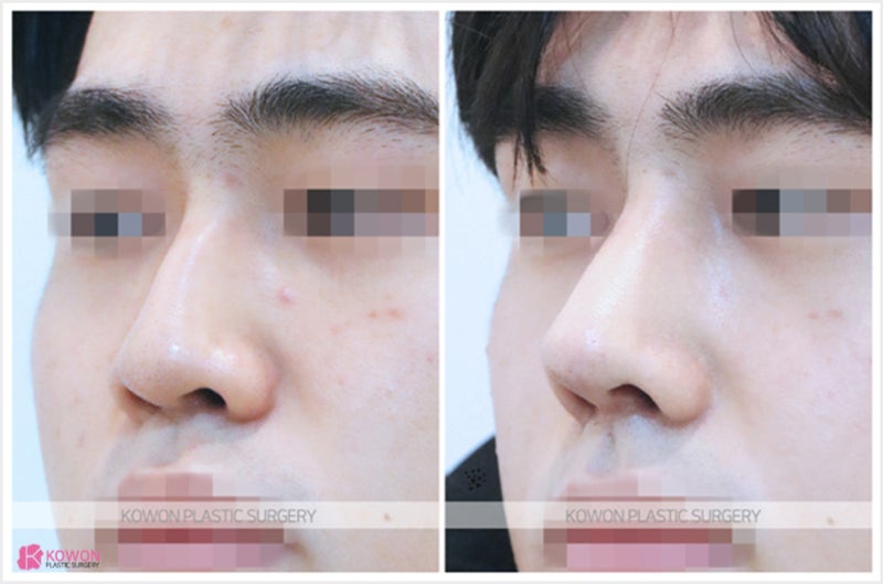 신사역성형외과 남자매부리코수술 연골 묶기 전후 사진 6