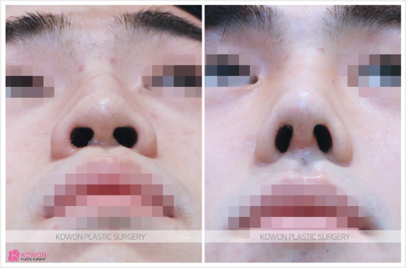 신사역성형외과 남자매부리코수술 연골 묶기 전후 사진 7