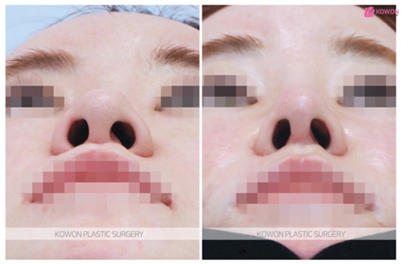 양악수술후코수술 보형물없는코성형 가능한 곳 사진 4