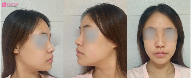 비중격만곡증 비염 수술 서울기능코성형 1주 및 3달 후기 사진 3