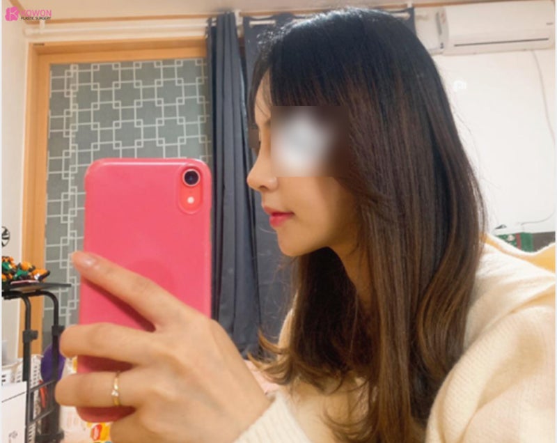 비중격만곡증 비염 수술 서울기능코성형 1주 및 3달 후기 사진 5