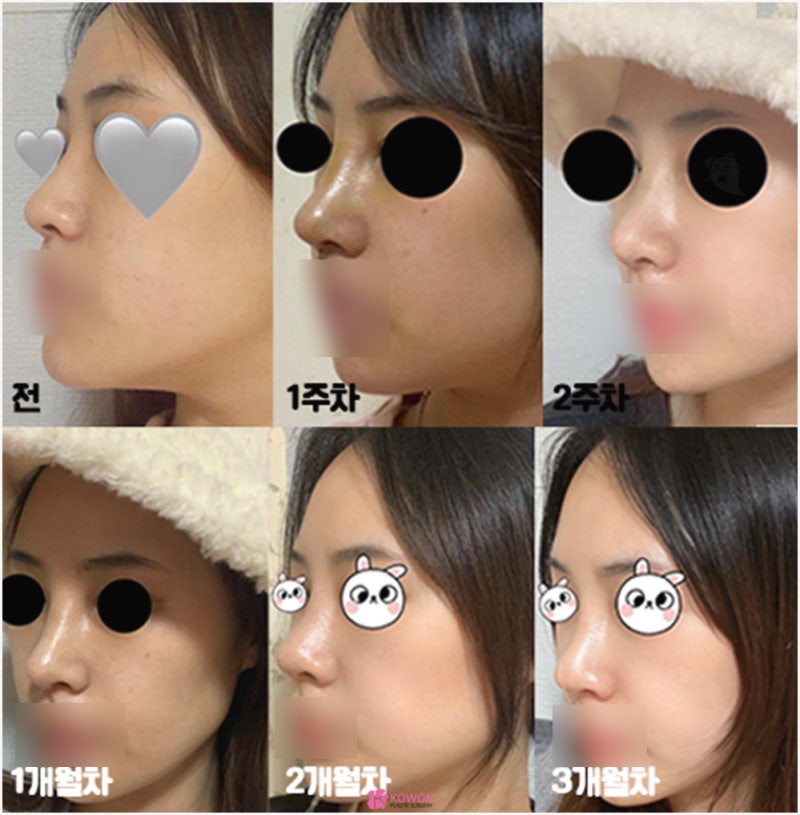 논현성형외과 코 전문 비중격만곡증수술후기 사진 14