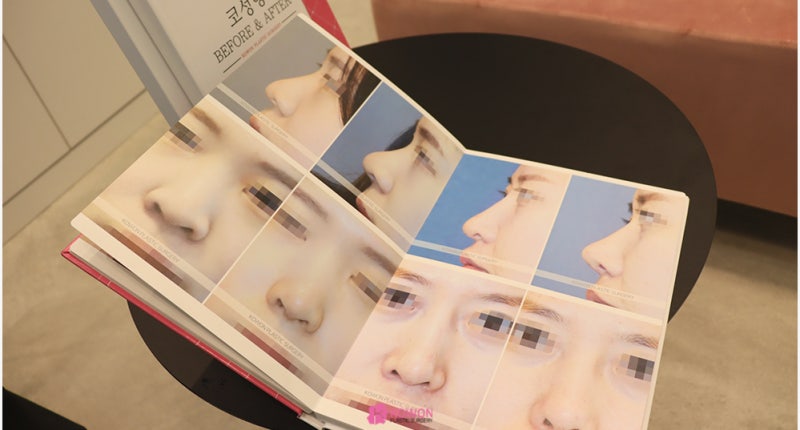 논현성형외과 코 전문 비중격만곡증수술후기 사진 2