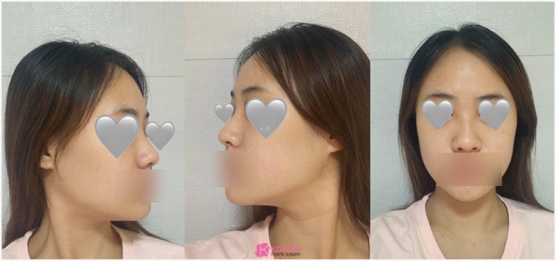 논현성형외과 코 전문 비중격만곡증수술후기 사진 3