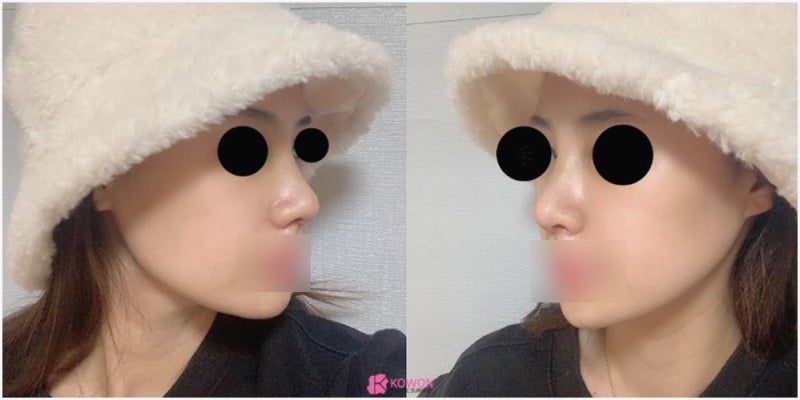 논현성형외과 코 전문 비중격만곡증수술후기 사진 8