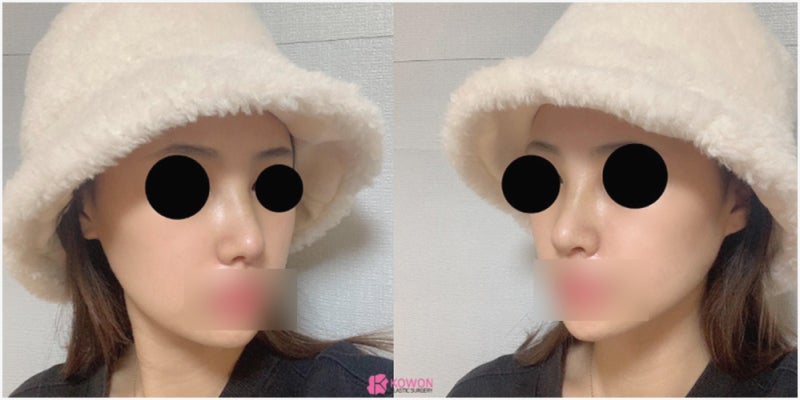 논현성형외과 코 전문 비중격만곡증수술후기 사진 9