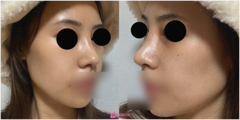 논현성형외과 코 전문 비중격만곡증수술후기 사진 11