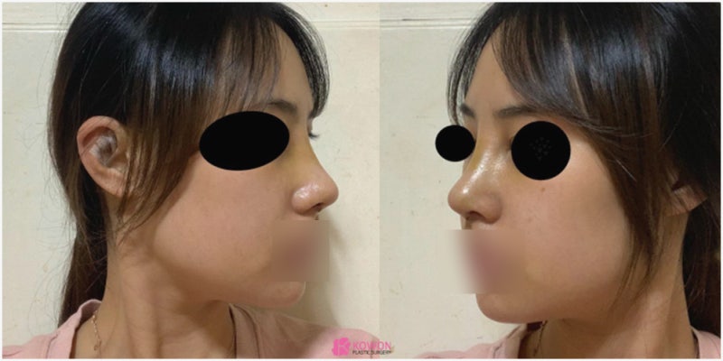 논현성형외과 코 전문 비중격만곡증수술후기 사진 6