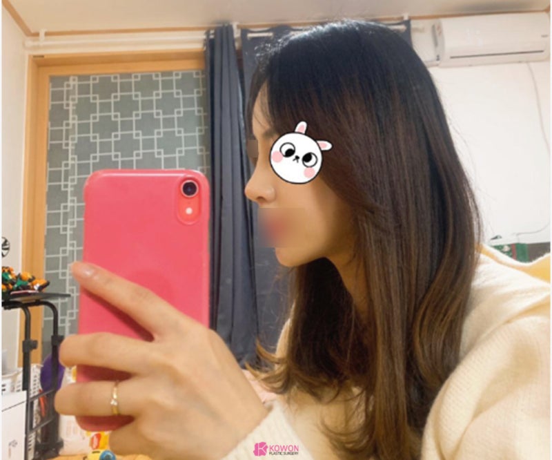 논현성형외과 코 전문 비중격만곡증수술후기 사진 5