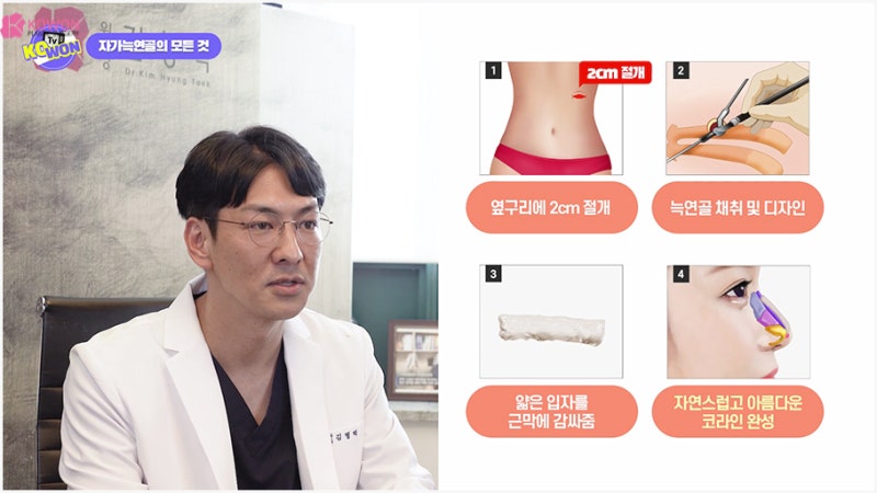 코수술잘하는곳 자가늑연골성형 방법과 장단점 사진 13