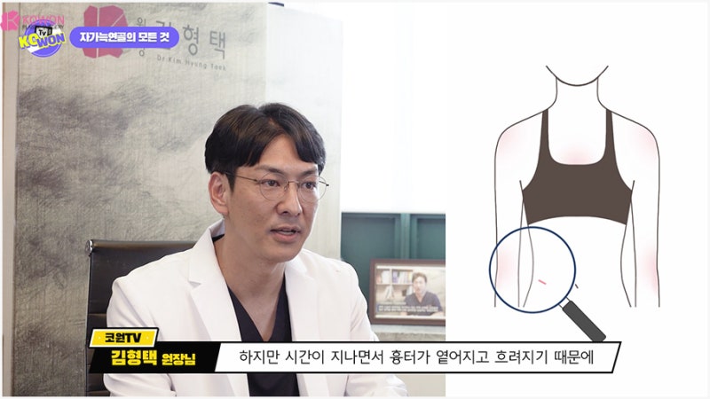 코수술잘하는곳 자가늑연골성형 방법과 장단점 사진 9
