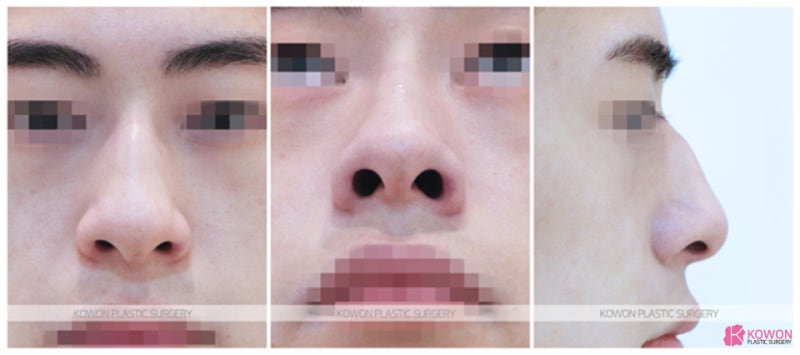 신사성형외과 무보형코수술로 원하는 코 모양 완성 사진 2