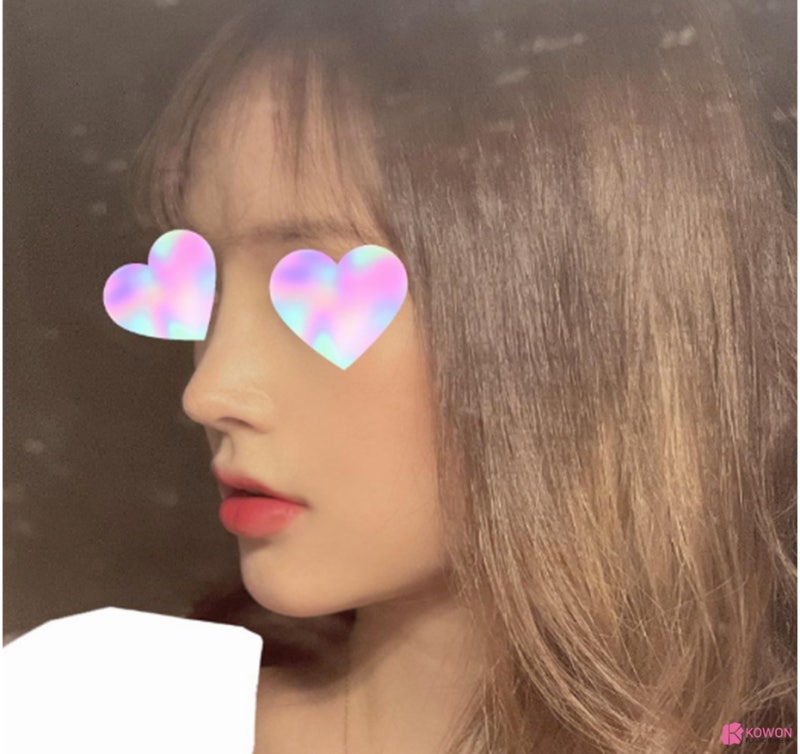 코필러후코성형 코원에서 재수술 화살코성형후기 사진 7