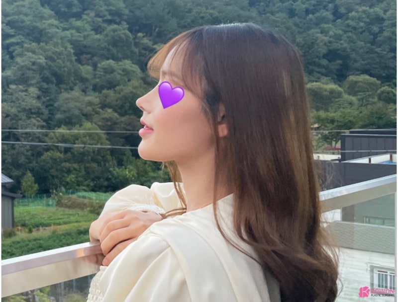 코필러후코성형 코원에서 재수술 화살코성형후기 사진 8