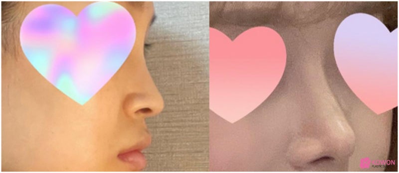 코필러후코성형 코원에서 재수술 화살코성형후기 사진 11