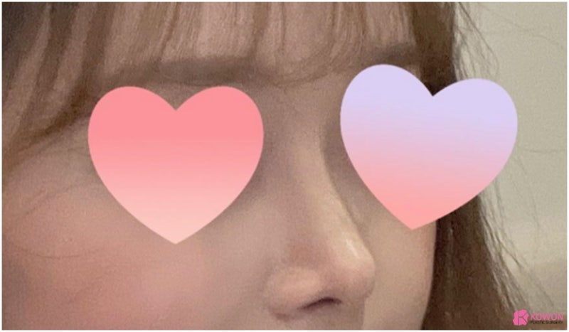 코필러후코성형 코원에서 재수술 화살코성형후기 사진 10