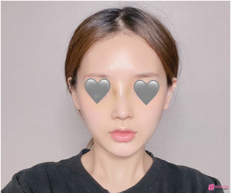 코필러후코성형 코원에서 재수술 화살코성형후기 사진 6
